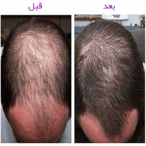 فیلر مو dr.cyj
