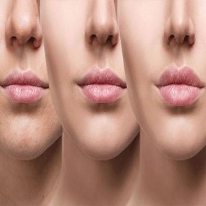 ژل نورامیس لیدوکائین