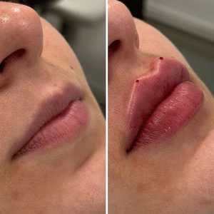 ژل نورامیس لایت لیدوکائین