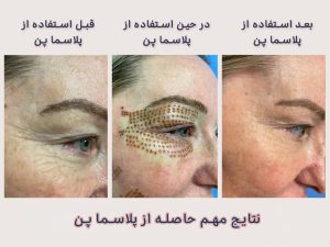 دستگاه پلاسما فیوژن PAA