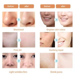 دستگاه هیدروفیشیال اسمارت آیس بلو