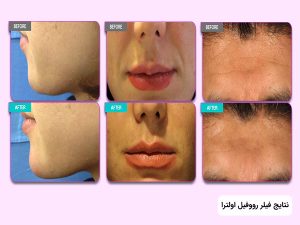 ژل اولترا رووفیل کره